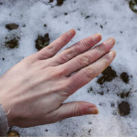 A hand showing Chillblains