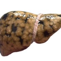 Close up of a fatty liver