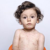 photo of child with measles