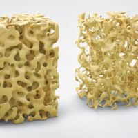 Three dimensional bone structure illustration showing normal bone and that with osteoporosis