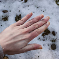 A hand showing Chillblains