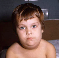 Young boy suffering from mumps