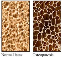 Image result for osteoporosis microscope