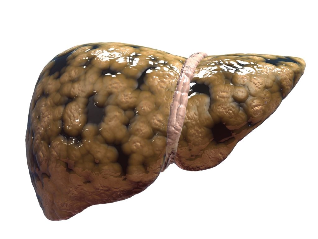 Close up of a fatty liver