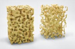 Three dimensional bone structure illustration showing normal bone and that with osteoporosis