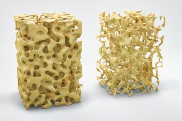 Three dimensional bone structure illustration showing normal bone and that with osteoporosis