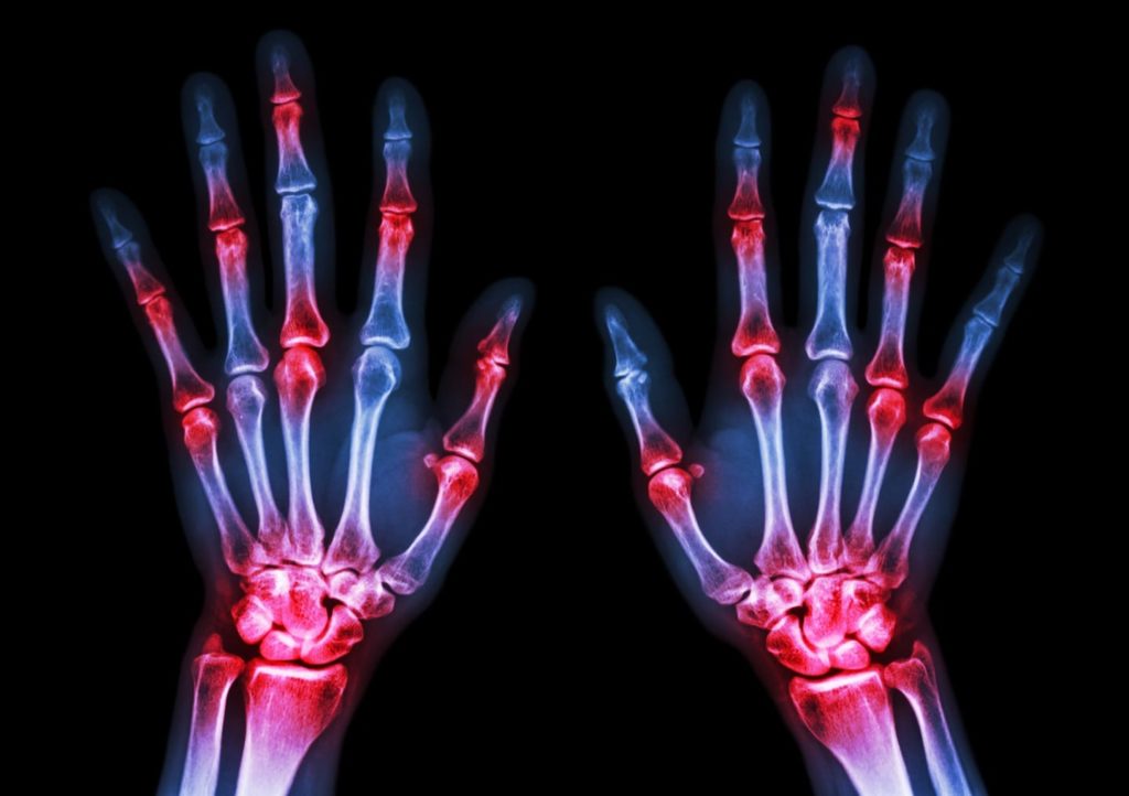 X-ray showing both human's hands and arthritis at multiple joints