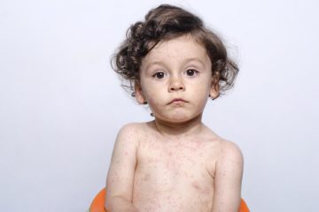 photo of child with measles