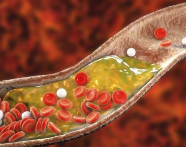 3D represntation of cholesterol in blood stream
