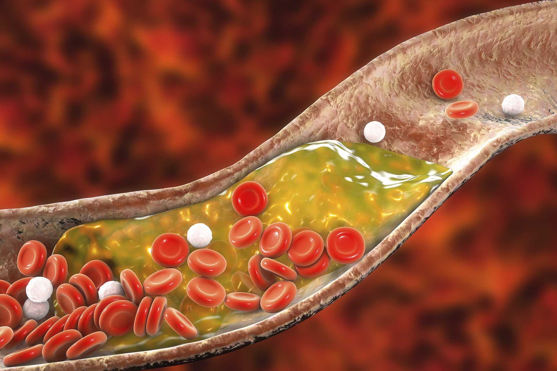 Lowering Blood Cholesterol - Your Health