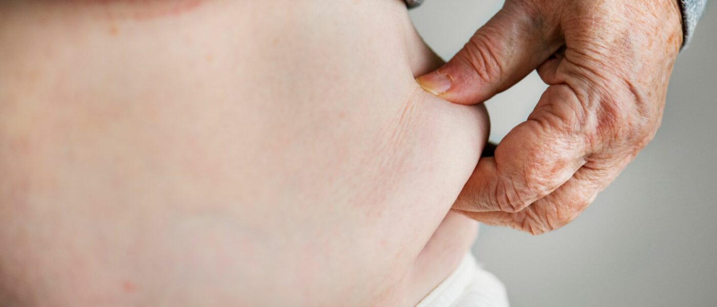 Person pinching body fat on stomach